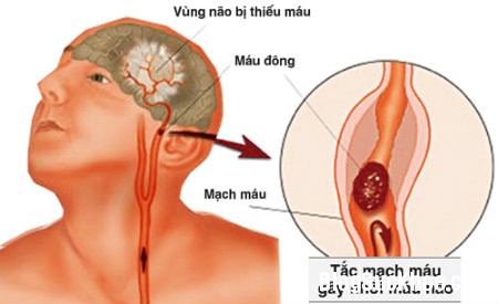 1152 Các biểu hiện của rối loạn tuần hoàn não