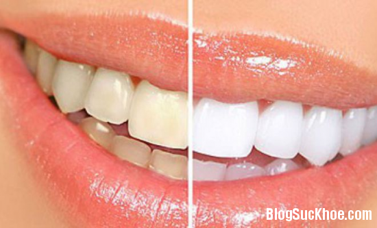 15 Quy trình tẩy trắng răng