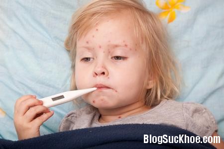 16 Cách điều trị bệnh sởi ở trẻ nhỏ
