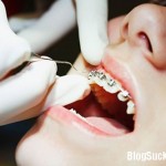 Cách chăm sóc răng miệng sau khi niềng