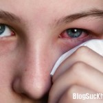 Cách chữa lẹo mắt
